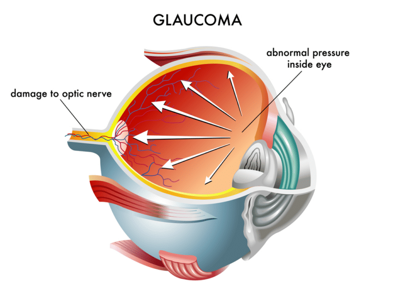Glaucoma Diagram